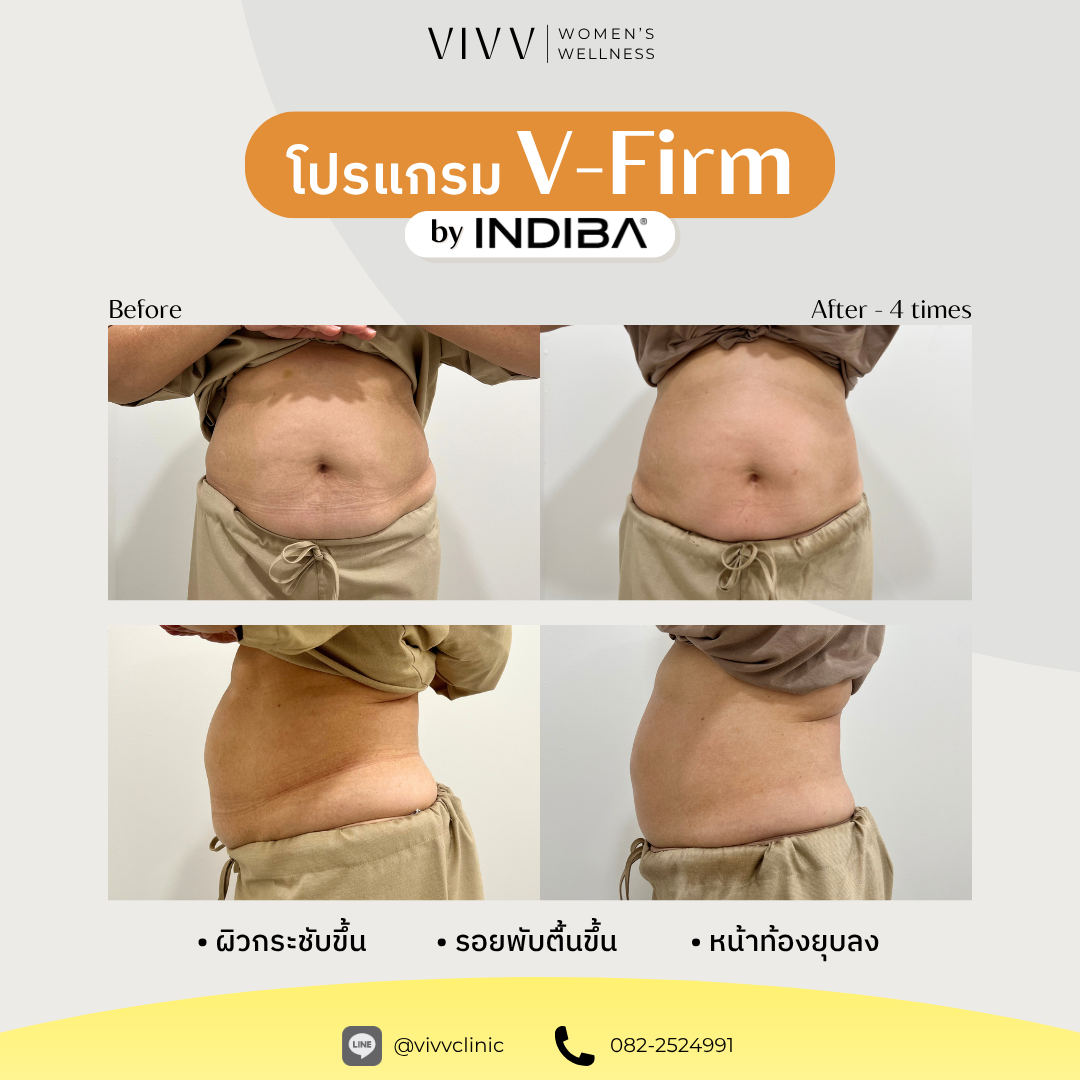 วิปป์ คลินิกเวชกรรม : โปรแกรม V-Firm by INDIBA
