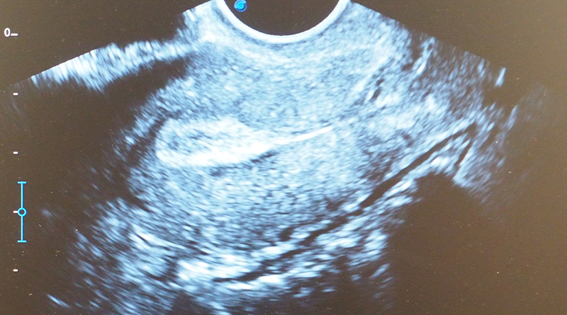 วิปป์ คลินิกเวชกรรม : อัลตราซาวด์ทางนรีเวช