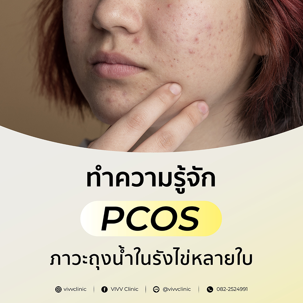 VIVV Clinic : สิวขึ้นเยอะ ขนดก ประจำเดือนมาไม่ปกติ...เป็น PCOS หรือเปล่านะ?